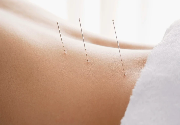 Acupuncture