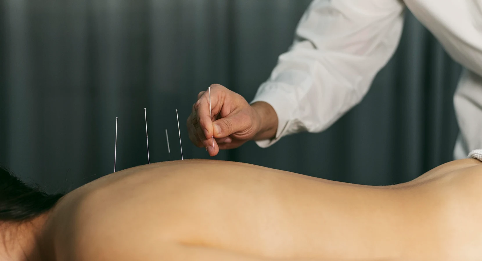 Acupuncture Treatment