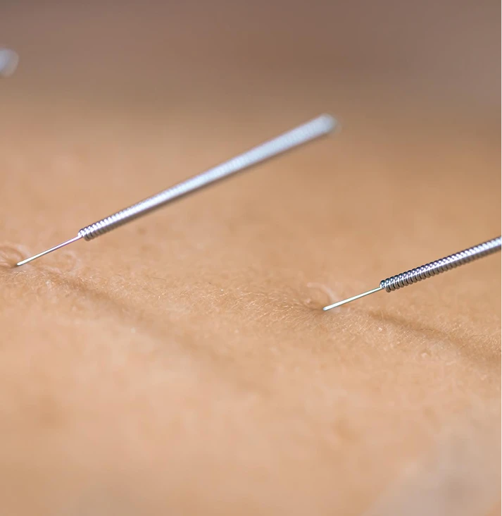 Acupuncture for Endometriosis