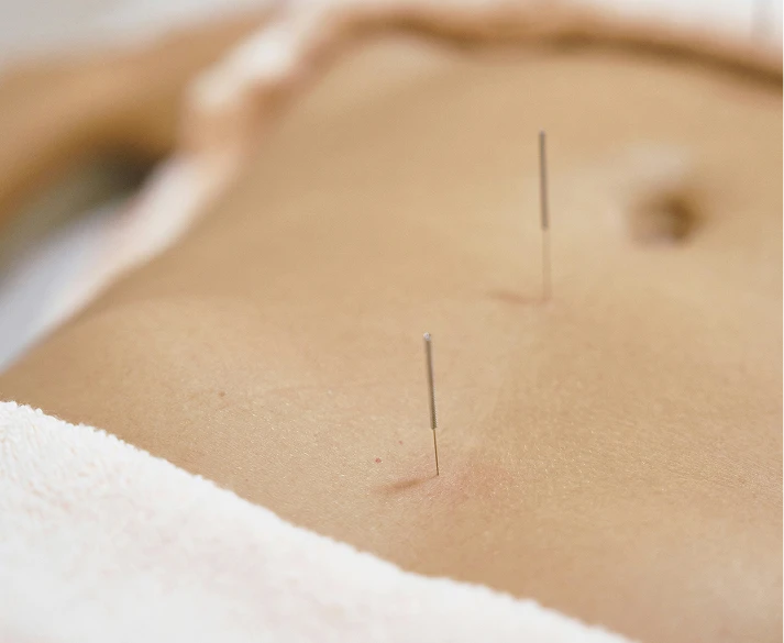 Acupuncture supporting Endometriosis