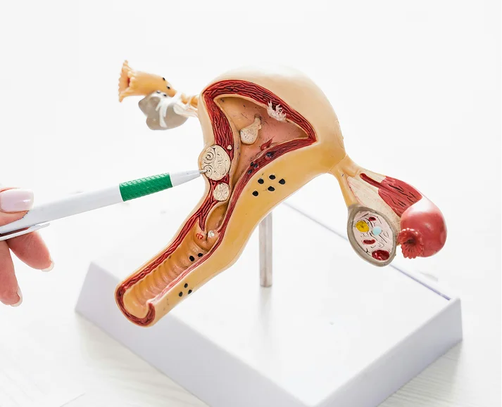 Endometriosis