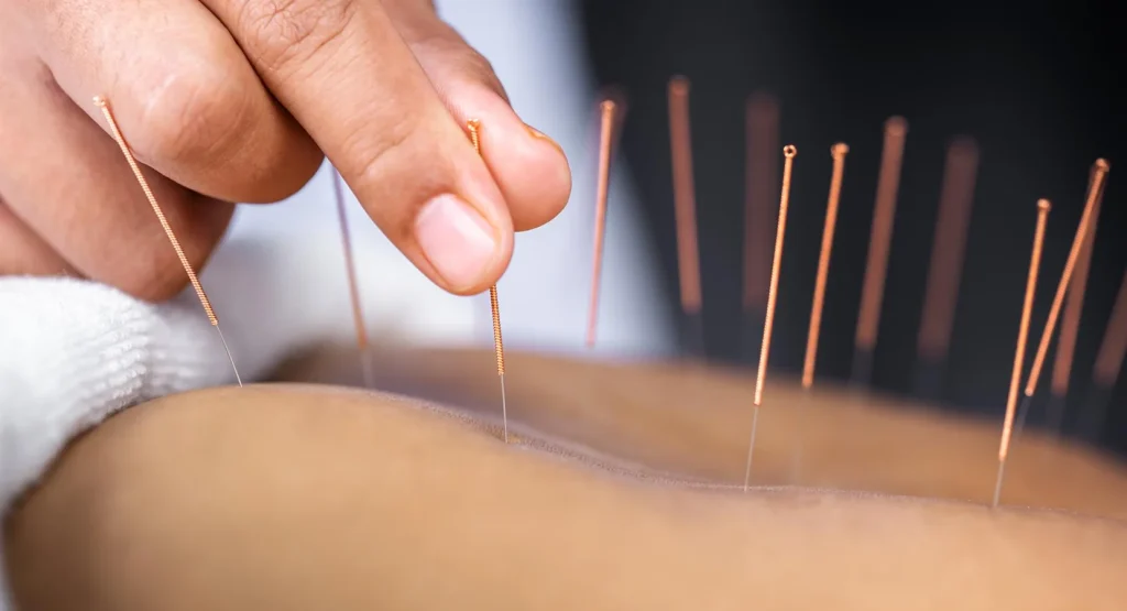 What is Acupuncture