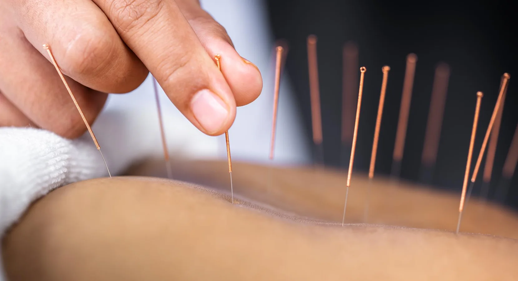 What is Acupuncture